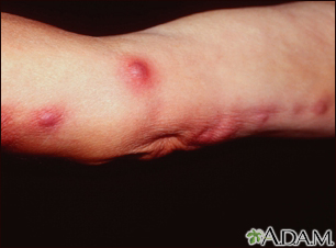 Sporotrichosis on the arm - Illustration Thumbnail
              
