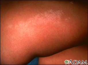 mayo clinic lichen planus