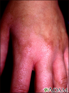 contact dermatitis fingers