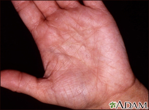 heat rash on hands and feet