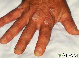 Use Of Topical Coal Tar Foam For The Treatment Of Psoriasis, 40% OFF