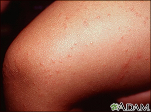 ebv rash amoxicillin