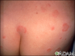 Hives (urticaria) on the back and buttocks - Illustration Thumbnail
                      