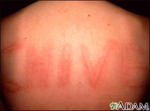 Dermatographism on the back - Illustration Thumbnail
                      