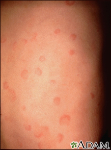 hives rash