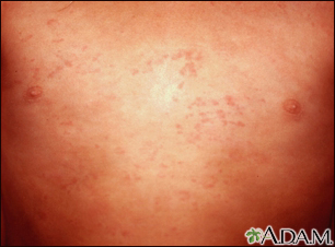 Hives or urticaria in children & teenagers