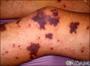 Figure 3 from Petechiae and purpura: the ominous and the not-so