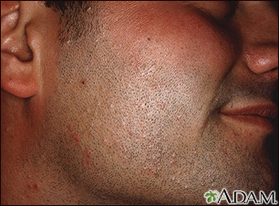 Hiv Lesions On Face