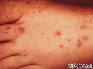 rocky mountain spotted fever rash dog