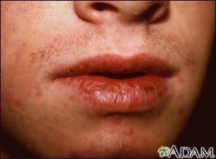 basal cell carcinoma lip