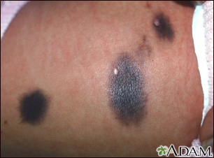 congenital nevus melanoma