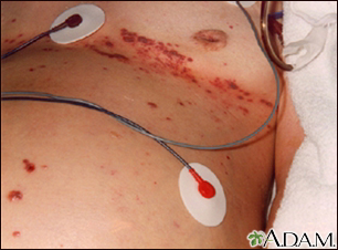 Shingles. Close-up of blisters around the groin of a 76-year-old female  patient with shingles. Shingles is a disease caused by the Herpes zoster  virus Stock Photo - Alamy