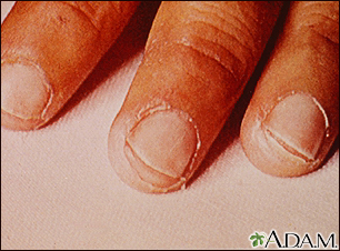 Kawasaki's disease - peeling of the fingertips - Illustration Thumbnail              