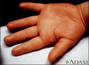 Kawasaki disease - edema of the hand