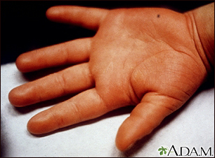 Kawasaki disease - edema of the hand - Illustration Thumbnail              