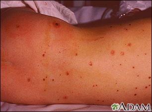 Meningococcal lesions on the back - Illustration Thumbnail              