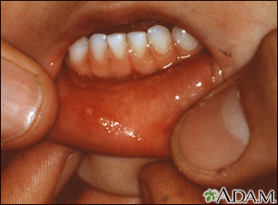Hand, foot, and mouth disease - mouth - Illustration Thumbnail
              