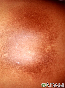 Skin - abnormally dark or light Information | Mount Sinai - New York