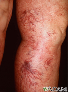 Telangiectasia Information