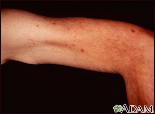 ataxia telangiectasia skin