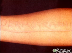 Photograph of a patient who developed moderate-to-severe allergic