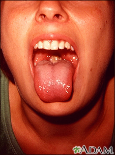 Mononucleosis (Mono or the Kissing Disease) Symptoms & Treatment