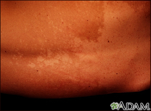 Tinea versicolor Information