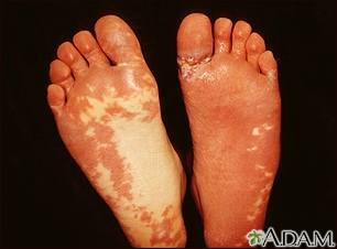 Sturge-Weber syndrome - soles of feet - Illustration Thumbnail
              