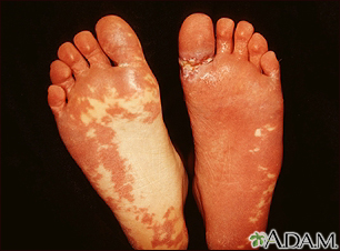 Sturge-Weber syndrome - soles of feet