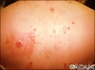 basal cell carcinoma early stages chest