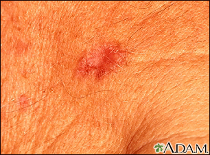 Basal Cell Carcinoma - close-up