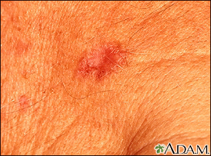 Basal Cell Carcinoma - close-up - Illustration Thumbnail
              