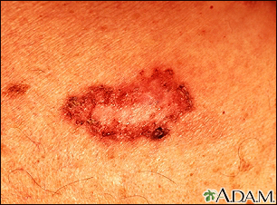 Basal cell carcinoma - close-up - Illustration Thumbnail
              