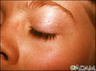 Nevoid basal cell carcinoma syndrome Information