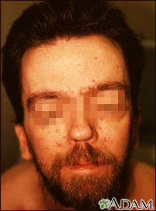 Nevoid basal cell carcinoma syndrome Information | Mount Sinai - New York