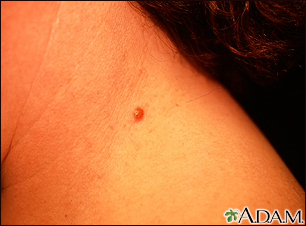 inflamed seborrheic keratosis