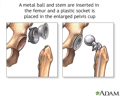 Hip joint replacement