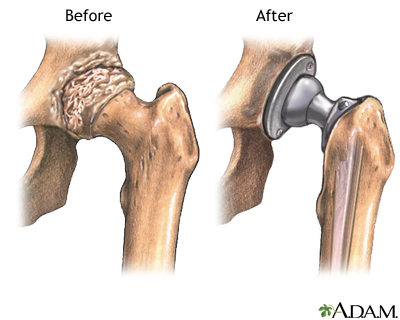Before and after hip joint replacement