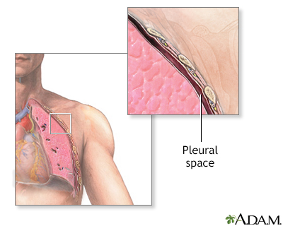 lung surgery for collapsed lung