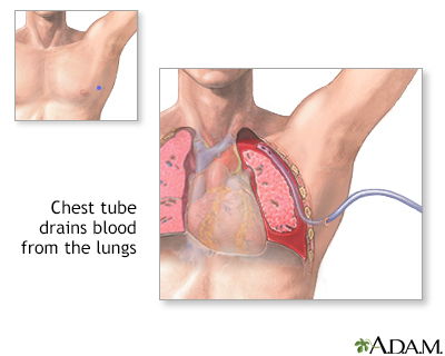 Chest tube insertion