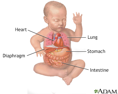 Diaphragmatic hernia repair - series - Presentation Thumbnail              