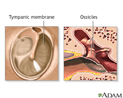 Eardrum repair - series - Presentation Thumbnail
              