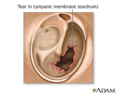 ruptured ear drum symptoms