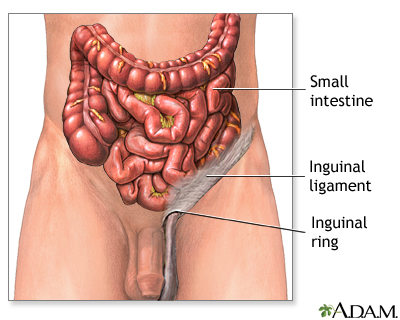 Inguinal hernia discharge Information Mount Sinai New York