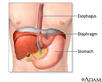 Hiatal hernia Information