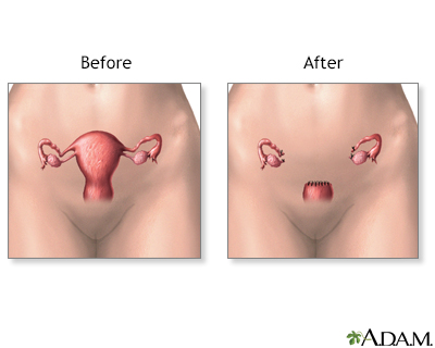 laparoscopic hysterectomy before and after