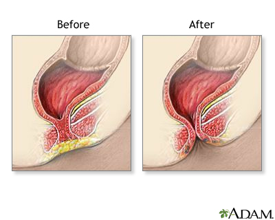 before and after anal  