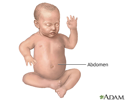 Omphalocele repair - series