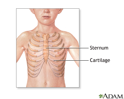 Is this pectus or rib flare? Or both? : r/PectusExcavatum