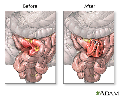 paralytic ileus